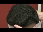 Frontal Hair Loss Transplantation 1 Year Result Before After Photos Dr. Diep www.mhtaclinic.com