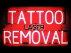 Laser Tattoo Removal Lewes DE Tattoo Removal