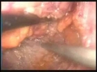 Abdominoperineal ressection for Rectal Cancer,National Cancer Institute of Brazil