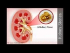 Kidney Stone Diet Chart