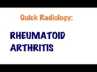 QUICK RADIOLOGY: Radiologic signs of Rheumatoid arthritis