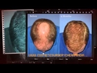 regrow hair - scalp med - shampoo for hair loss - Dr. Ari Arumugam - Plastic