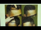 Frontal Hair Loss Result on Asian Man Norwood 3 Hair Transplant Dr. Diep www.mhtaclinic.com