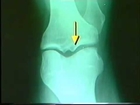 arthritis   knee pain   forever freedom