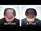 hair growth journey before and after - how to increase hair growth naturally for men