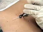 belly button piercing operation