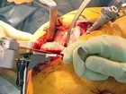 Minimally Invasive Total Knee Replacement Surgery Video - Brigham and Women's Hospital